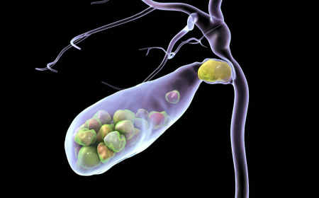 تناول كميات أكبر من السكر يزيد احتمالية الإصابة بالمرض..حصى المرارة... كيف تتكون وما طرق تشخيصها؟