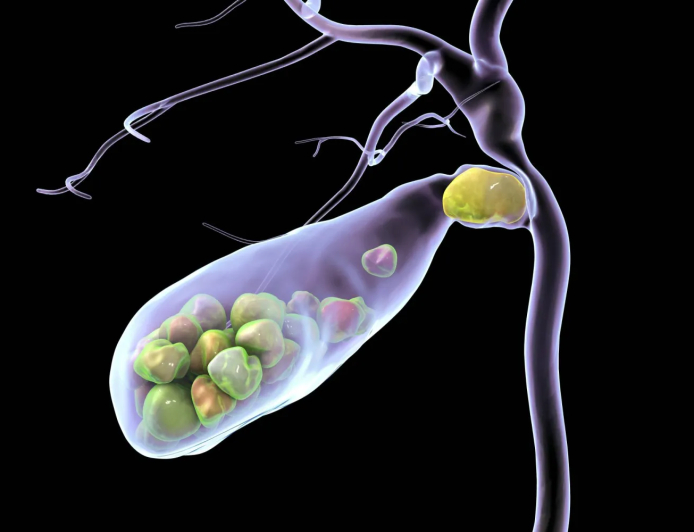 تناول كميات أكبر من السكر يزيد احتمالية الإصابة بالمرض..حصى المرارة... كيف تتكون وما طرق تشخيصها؟