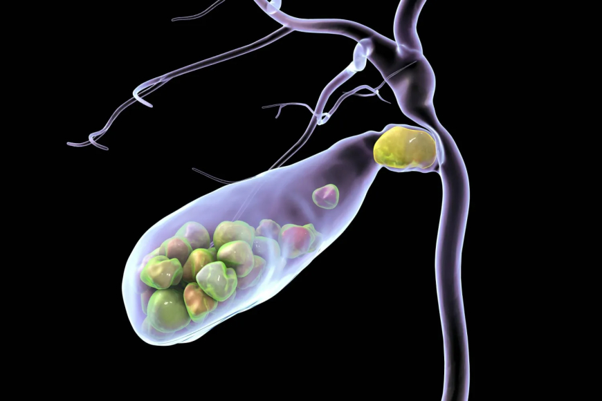 تناول كميات أكبر من السكر يزيد احتمالية الإصابة بالمرض..حصى المرارة... كيف تتكون وما طرق تشخيصها؟
